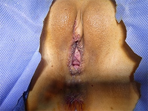 labiaplasty-patient-15-after