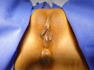 labiaplasty-patient-15-before