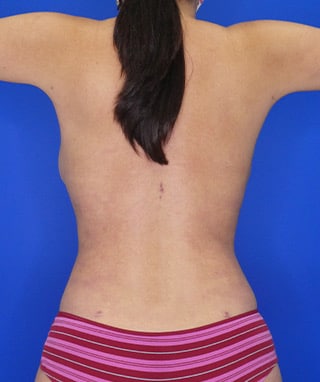 Liposuction after, case 1166, back view