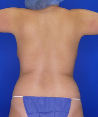 Liposuction before, case 1166, back view