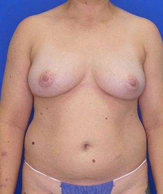 Liposuction before, case 1165, front view