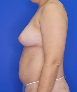Liposuction before, case 1165, side view