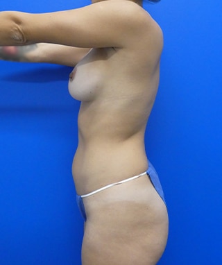 Liposuction before, case 1164, side view