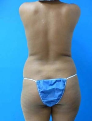 Liposuction before, case 1163, back view