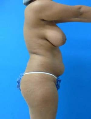 Liposuction before, case 1163, side view