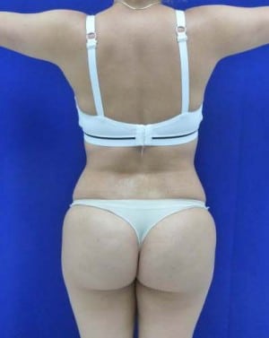 Liposuction after, case 1162, back view