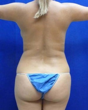 Liposuction before, case 1162, back view