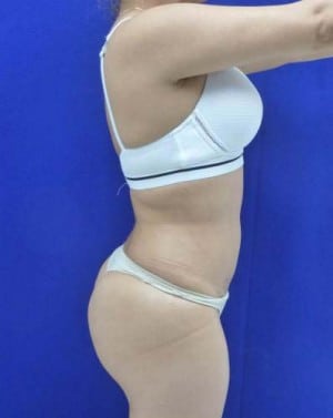 Liposuction after, case 1162, side view