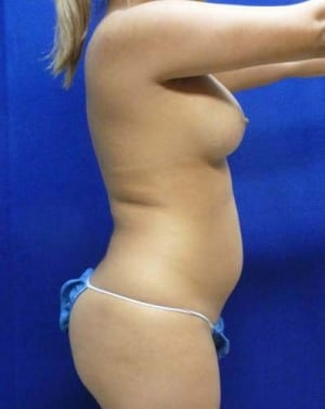 Liposuction before, case 1162, side view