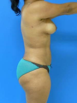 Liposuction after, case 1161, side view