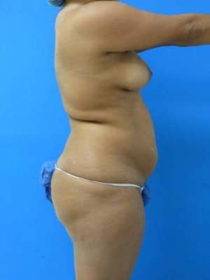 Liposuction before, case 1161, side view