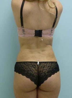 Liposuction after, case 1160, back view