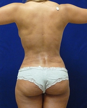 Liposuction after, case 1159, front view