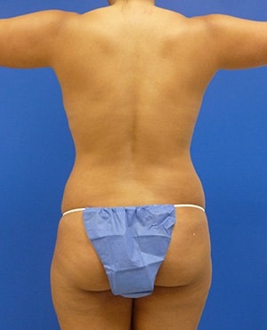 Liposuction before, case 1159, front view