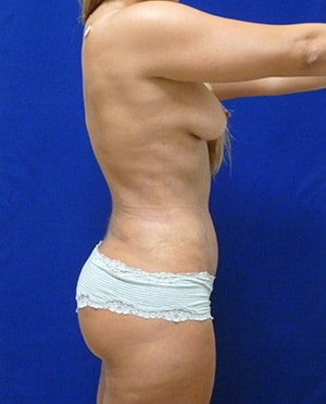 Liposuction after, case 1159, side view