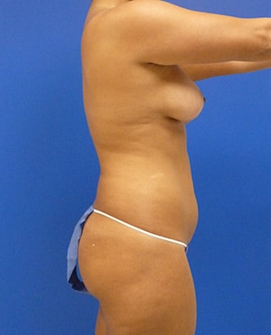 Liposuction before, case 1159, side view