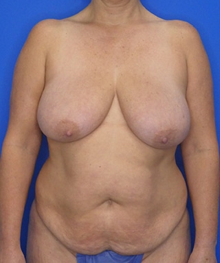 Mommy Makeover before, case 1169, front view