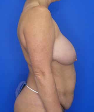 Tummy Tuck before, case 1095, side view