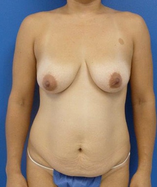 Mommy Makeover before, case 1190, front view