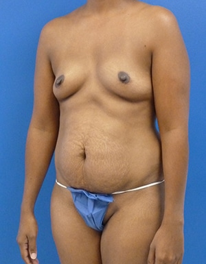 Mommy Makeover before, case 1189, angle view