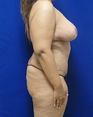 Mommy Makeover after, case 1187, side view