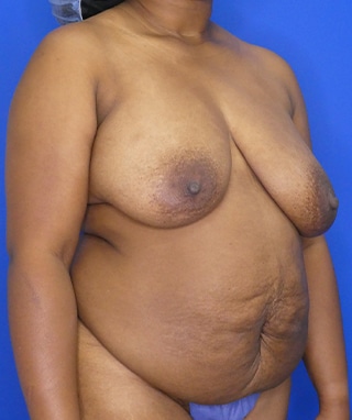 Mommy Makeover before, case 1186, oblique view