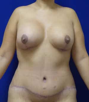 Mommy Makeover after, case 1184, front view
