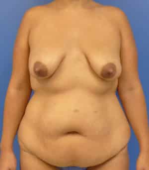 Mommy Makeover before, case 1184, front view