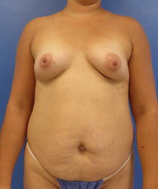 Mommy Makeover before, case 1179, front view