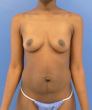 Mommy Makeover before, case 1177, front view