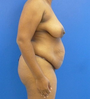 Mommy Makeover before, case 1176, side view