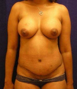 Mommy Makeover after, case 1175, front view