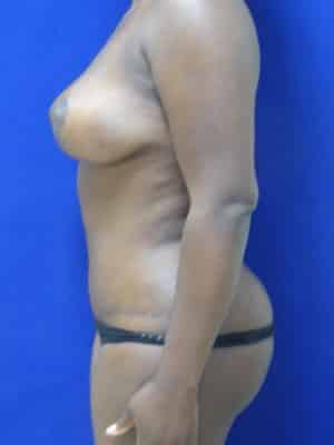 Mommy Makeover after, case 1171, side view