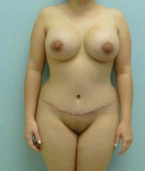Mommy Makeover after, case 1195, front view