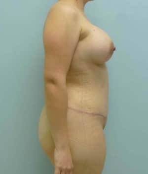 Mommy Makeover after, case 1195, side view