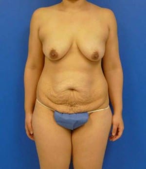 Mommy Makeover before, case 1194, front view