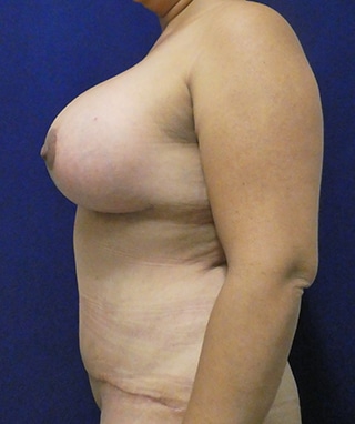 Mommy Makeover after, case 1192, side view