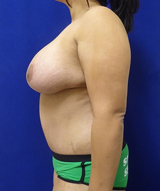 Mommy Makeover after, case 1191, side view