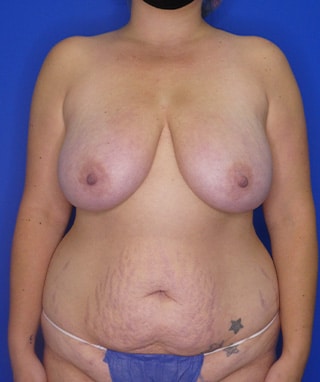 Tummy Tuck before, case 1094, front view