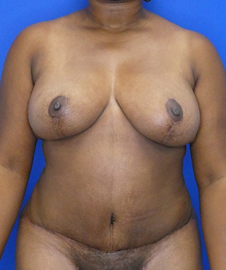 Tummy Tuck after, case 1158, front view