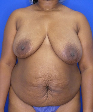 Tummy Tuck before, case 1158, front view