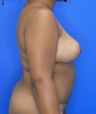 Tummy Tuck after, case 1158, side view