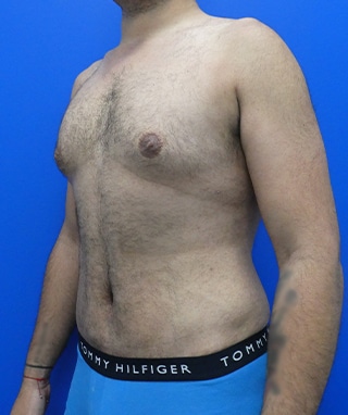 Tummy Tuck after, case 1149, angle view