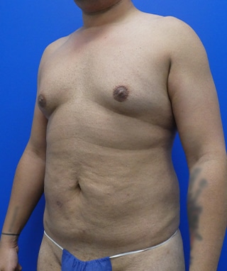 Tummy Tuck before, case 1149, angle view