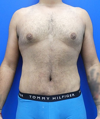 Tummy Tuck after, case 1149, front view