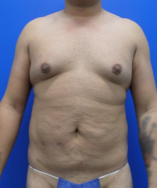 Tummy Tuck before, case 1149, front view