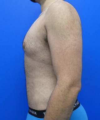 Tummy Tuck after, case 1149, side view