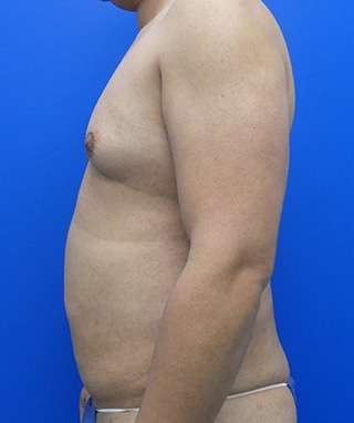 Tummy Tuck before, case 1149, side view