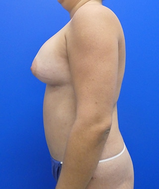 Tummy Tuck after, case 1148, side view