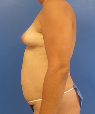 Tummy Tuck before, case 1148, side view